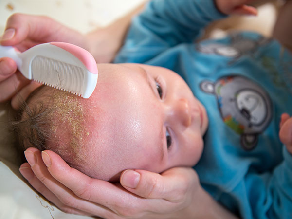Baby with cradle cap