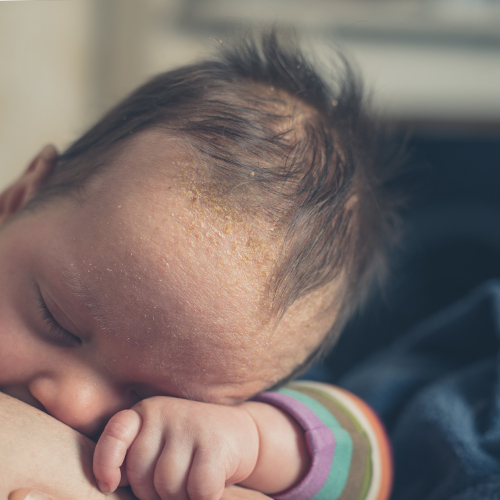 what is cradle cap