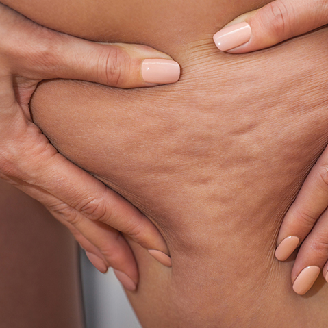 10 facts about cellulite