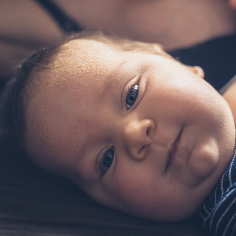 What is cradle cap?